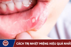 Cách Trị Nhiệt Miệng Nhanh Chóng, Hiệu Quả Tại Nhà